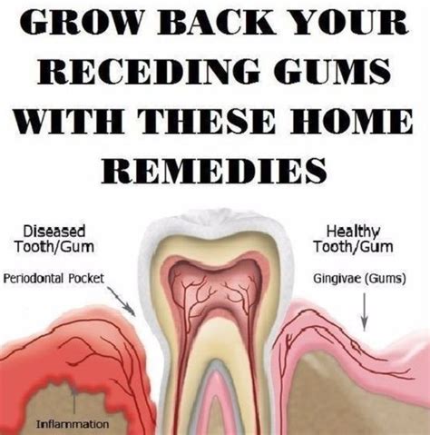 Gingivitis Usually Known As Gum Disease Is A Dental Issue
