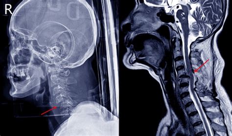 Premium Photo Xray Image And Mri Of Cervical Spine Case Trauma
