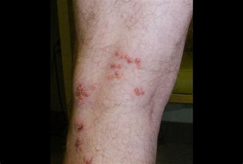 Cat Scratch Disease As Related To Dermatitis Pictures