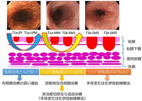 食道がん｜がんに関する情報｜がん研有明病院