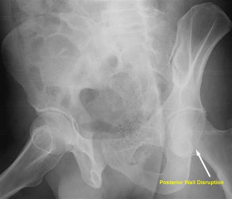 Acetabular Fractures Trauma Orthobullets