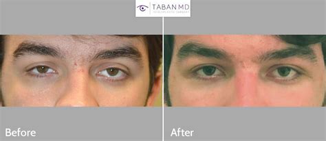 Eye Asymmetry Before And After Photos Taban Md