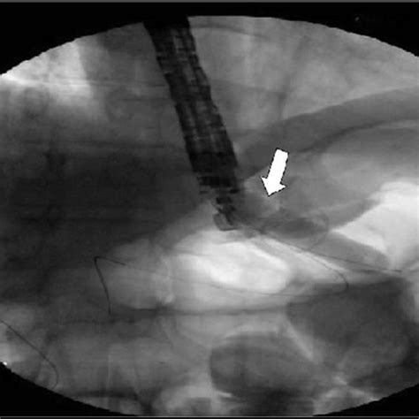 Radiographic Finding During Ercp Intervention Common Bile Duct Is