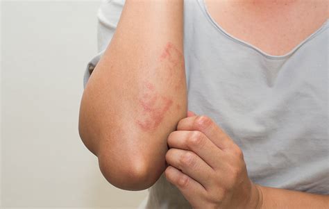5 Types Of Eczema Commonly Found In Older Adults Plus Treatment