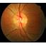 Optic Neuritis  Pictures Symptoms Causes Diagnosis Treatment