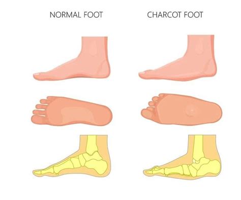 Charcot Foot Treatment Singapore Sbf Sports