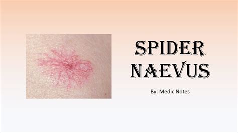 Spider Naevus Causes Pathophysiology Sign Value Youtube