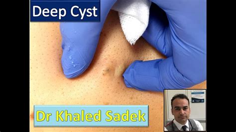 Deep Sebaceous Cyst Dr Khaled Sadek Youtube