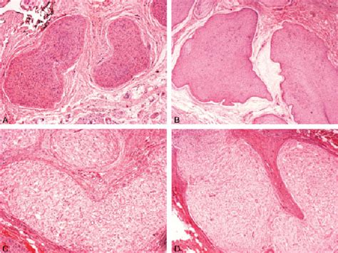 Histopathological Findings Of Plexiform Neurofibroma A Cylindrical