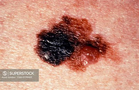 Skin Cancer Malign Melanoma On Arm Superstock