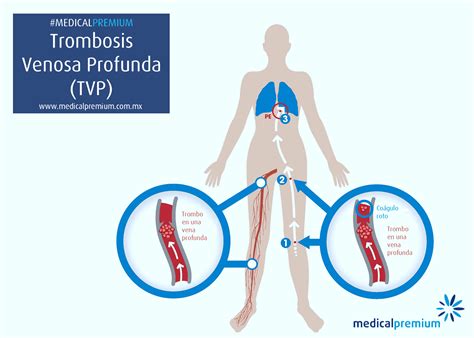 Trombosis Pulmonar Que Es Puede Estar Presente En Diversas Patolog As Como El Neumot Rax