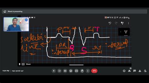 How To Read Ecg Electrocardiogram And Related Disease In Easy Manner By