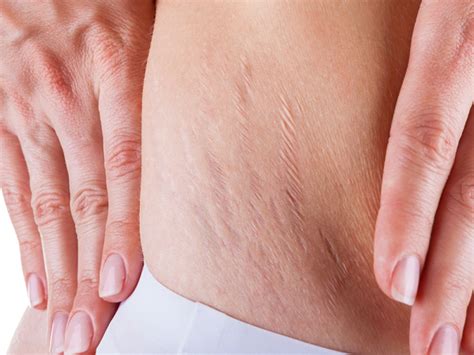 what causes cellulite in men and how to fix it flab fix