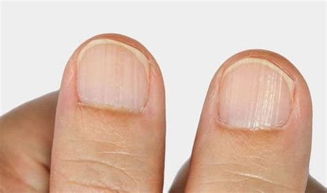 The 5 Signs In Your Nails You Have A Vitamin Deficiency From White Spots To Grooves Express