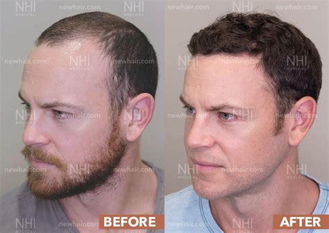 Before And After Hair Transplants For Men