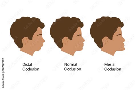 Guy With Distal Normal And Mesial Bite Profile Vector Illustration