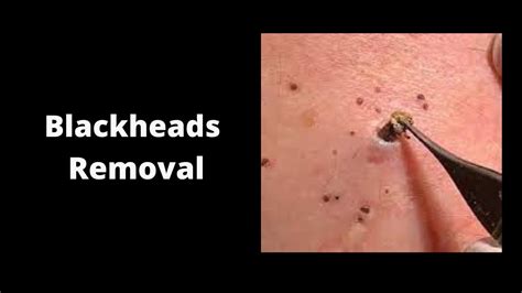 Blackheads Removal And Pimple Popping Videos 2021 Youtube