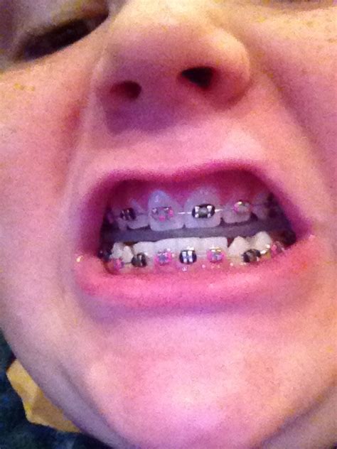 Diy Fake Braces For Halloween Very Simple Choice Podcast Pictures Gallery