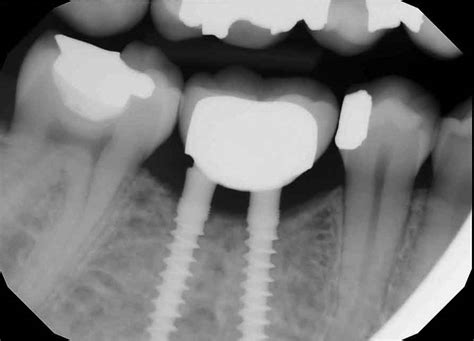 Mini Implant 2 Decisions In Dentistry