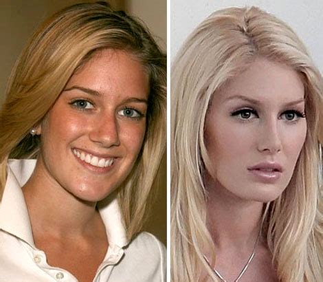 Heidi Montag Before And After Plastic Surgery Best Plastic Surgeon