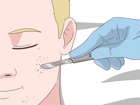 Ways To Get Rid Of Acne Cysts Fast Wikihow