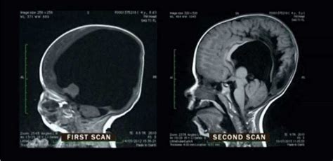 These Are Mri Scans Of A Boy Born With Only 2 Of His Brain And 2 Years