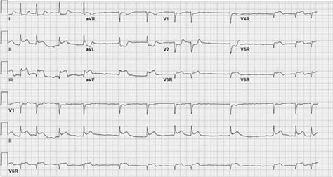 The Right Sided Ecg For The Right Diagnosis Circulation