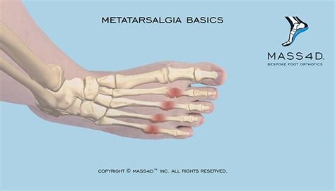 Metatarsalgia Basics