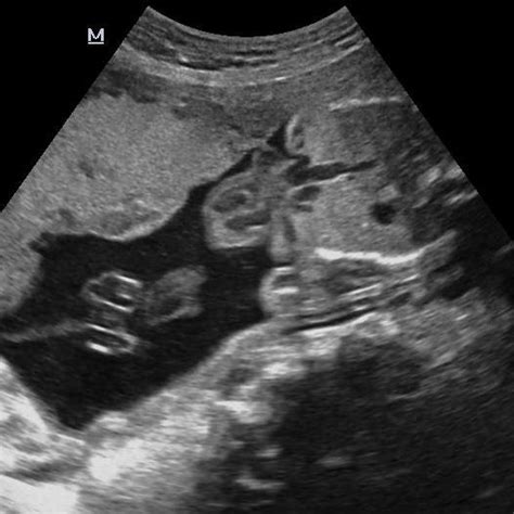 A Ultrasound Image Through The Fetal Thorax Showing Complete