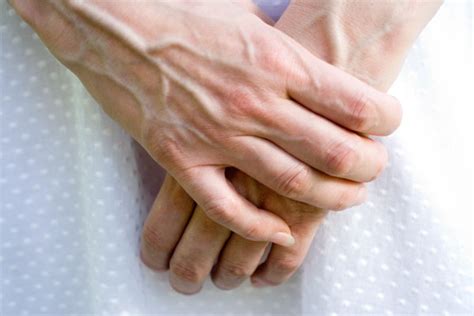 What Causes Bulging Veins In Hands