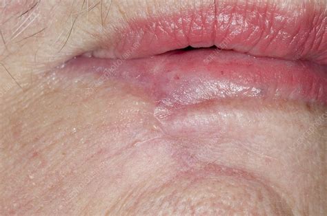 Excised Skin Cancer Of The Lip Stock Image C0147968 Science