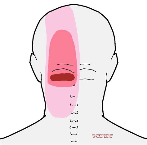 Trigger Points Headache At The Back Of Your Head Integrative Works