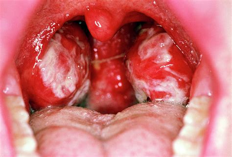 Tonsils Of Person With Glandular Fever Photograph By Dr P Marazzi