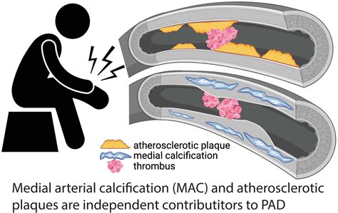 Medial Arterial Calcification A Significant And Independent