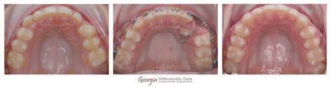 Georgia Orthodontic Care Lawrenceville And Norcross Ga