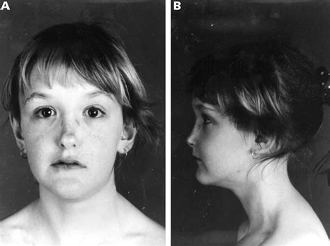 Sotos Syndrome And Cutis Laxa Journal Of Medical Genetics