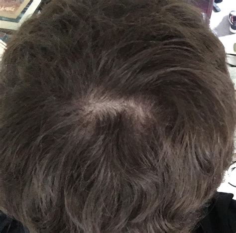 Is This Balding Or Cowlick And How Do I Fix It Hair Beauty Skin