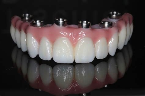 All On Four Implants Your Key To Full Mouth Restoration Ratten Paradies
