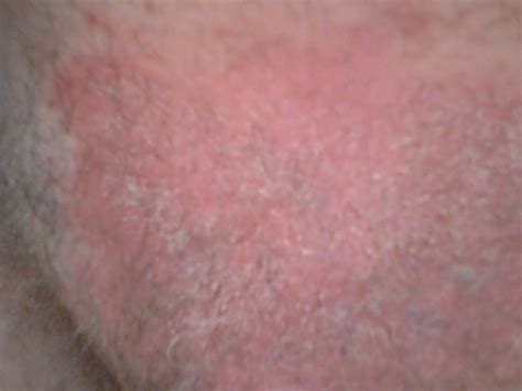 What Is Causing This Rash In My Groin Area See Photo It