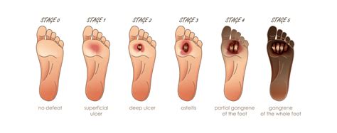 Good Foot Care Is Important For People Who Have Diabetes