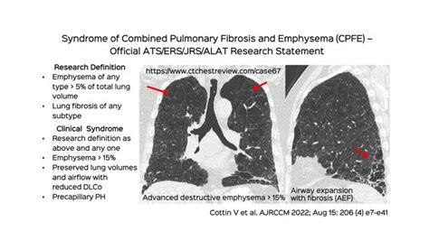 Emphysema Ct Chest Review