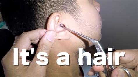 Removing An Unusual Foreign Body Piece Of Hair Stuck In Mans Ear