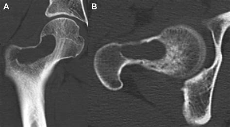 Endoscopic Surgery For Symptomatic Unicameral Bone Cyst Of The Proximal Femur Arthroscopy
