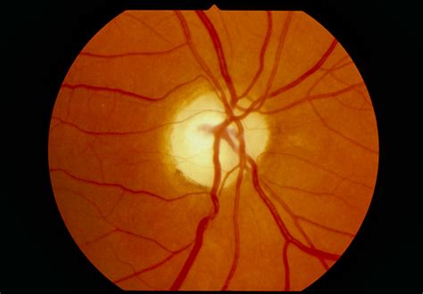 Algorithm Can Identify Retinal Atrophy Cause Ophthalmology Advisor