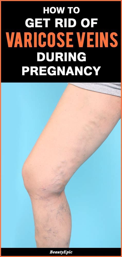 How To Get Rid Of Varicose Veins During Pregnancy Varicose Vein Removal