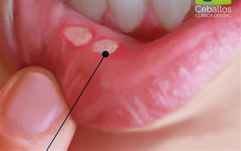 LAS AFTAS BUCALES Clínica Dental Ceballos