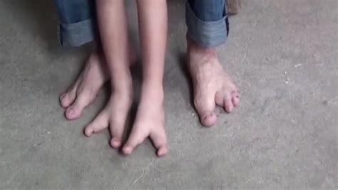 Dads Moving Wish For Five Year Old Son Who Was Born With Just Two Toes