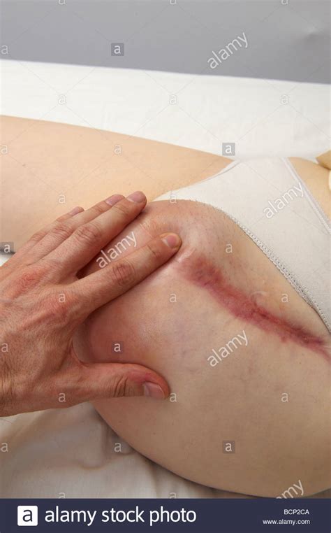 Frau mit Amputation des Beins deren Hüfte geschwollene Monate Post Op auf Krebs