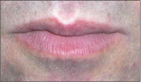 What Causes Loss Of Lip Color