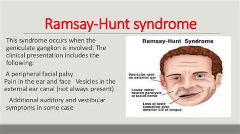 Ramsay Hunt Syndrome Neuro1hub